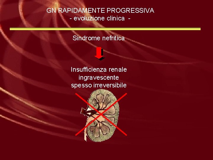 GN RAPIDAMENTE PROGRESSIVA - evoluzione clinica Sindrome nefritica Insufficienza renale ingravescente spesso irreversibile 