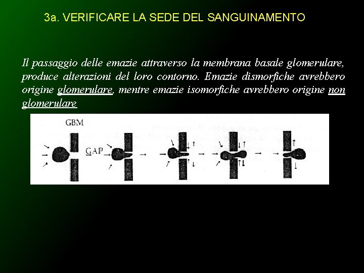 3 a. VERIFICARE LA SEDE DEL SANGUINAMENTO Il passaggio delle emazie attraverso la membrana