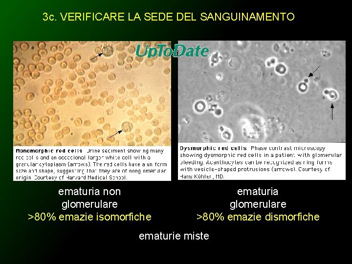 3 c. VERIFICARE LA SEDE DEL SANGUINAMENTO ematuria non glomerulare >80% emazie isomorfiche ematuria