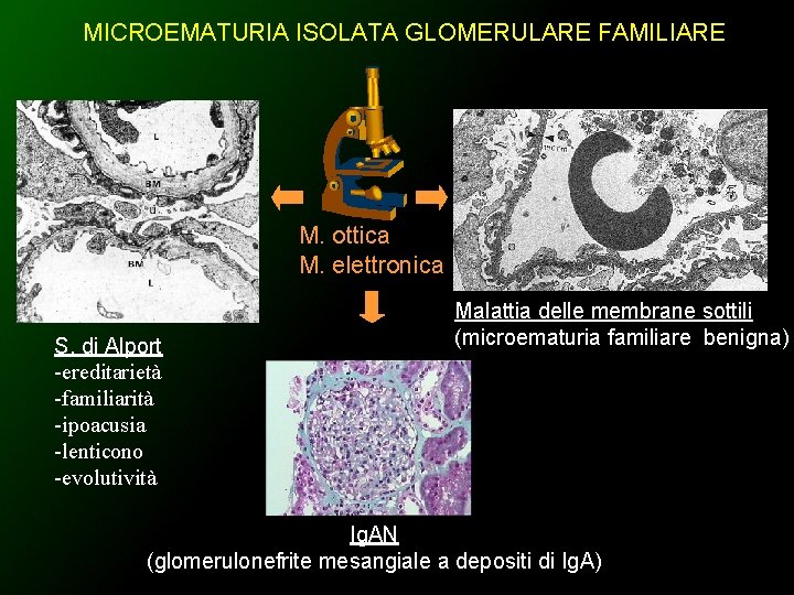 MICROEMATURIA ISOLATA GLOMERULARE FAMILIARE M. ottica M. elettronica S. di Alport -ereditarietà -familiarità -ipoacusia
