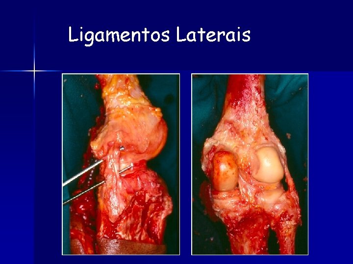 Ligamentos Laterais 