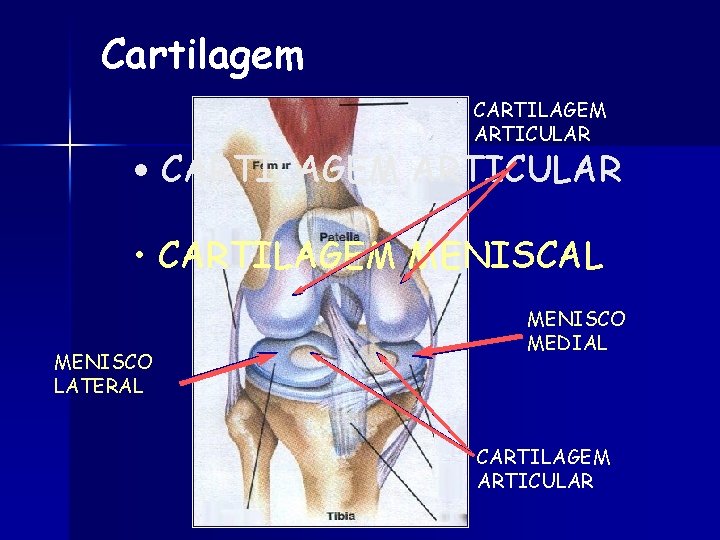 Cartilagem CARTILAGEM ARTICULAR • CARTILAGEM ARTICULAR • CARTILAGEM MENISCAL MENISCO LATERAL MENISCO MEDIAL CARTILAGEM