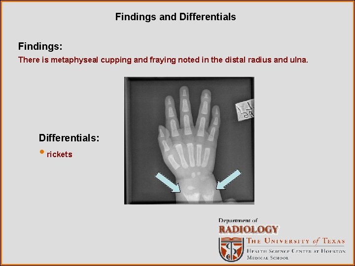 Findings and Differentials Findings: There is metaphyseal cupping and fraying noted in the distal