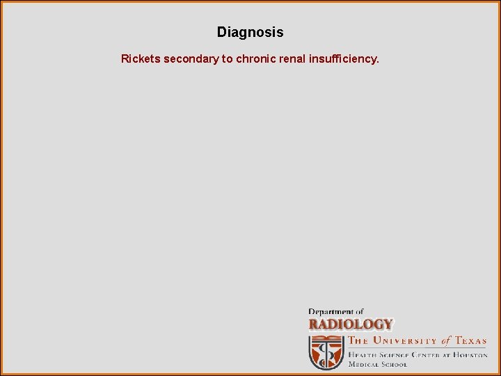 Diagnosis Rickets secondary to chronic renal insufficiency. 