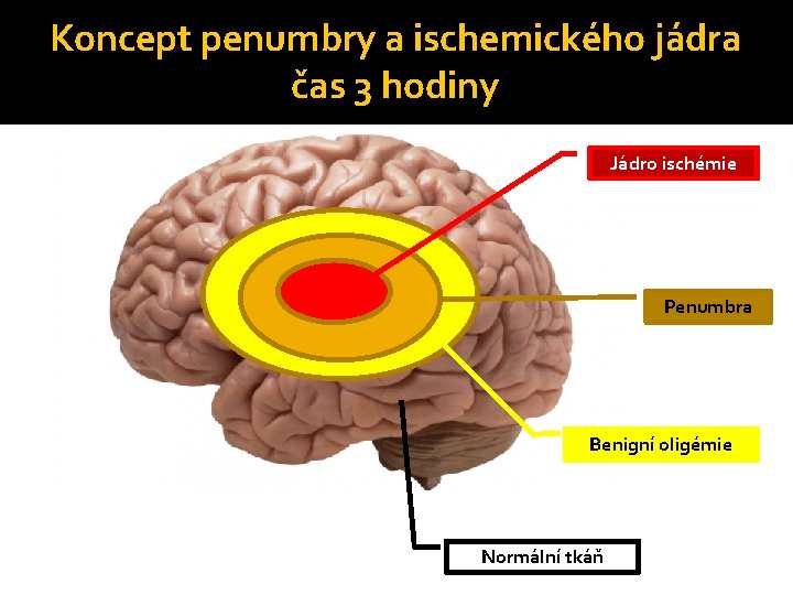 Koncept penumbry a ischemického jádra čas 3 hodiny Jádro ischémie Penumbra Benigní oligémie Normální