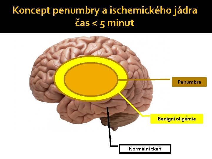 Koncept penumbry a ischemického jádra čas < 5 minut Penumbra Benigní oligémie Normální tkáň