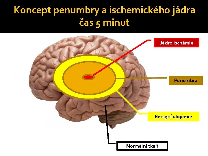 Koncept penumbry a ischemického jádra čas 5 minut Jádro ischémie Penumbra Benigní oligémie Normální