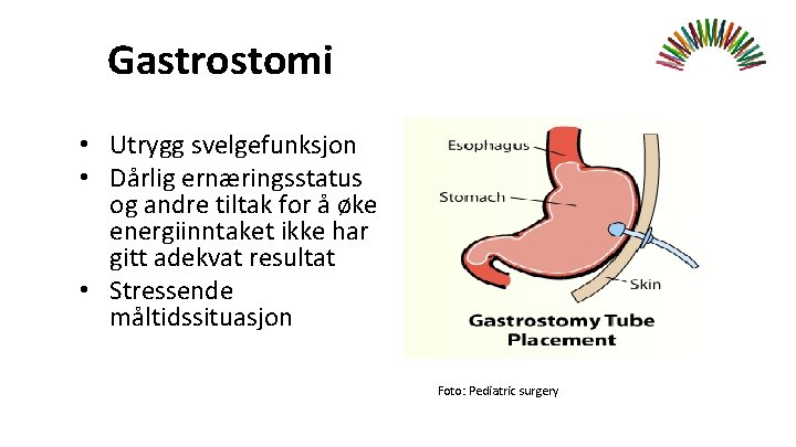 Gastrostomi • Utrygg svelgefunksjon • Dårlig ernæringsstatus og andre tiltak for å øke energiinntaket