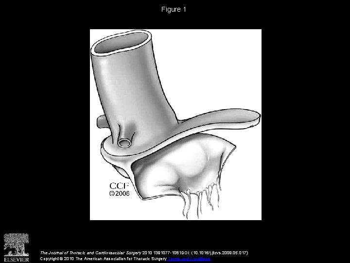 Figure 1 The Journal of Thoracic and Cardiovascular Surgery 2010 1391077 -1081 DOI: (10.