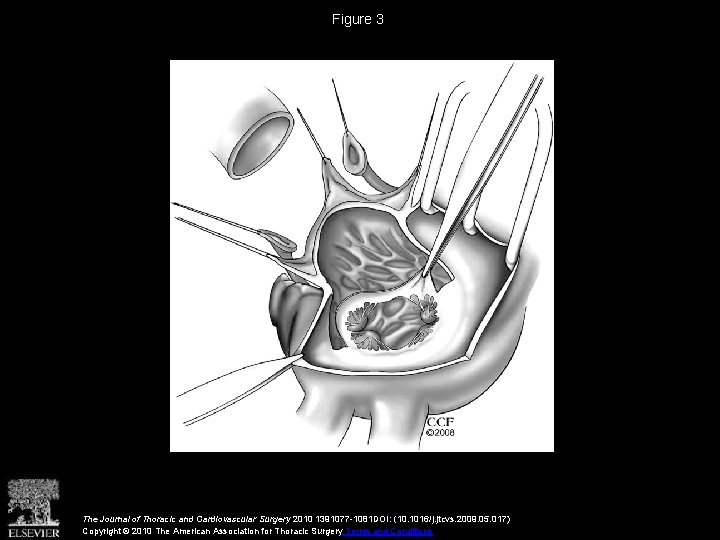 Figure 3 The Journal of Thoracic and Cardiovascular Surgery 2010 1391077 -1081 DOI: (10.