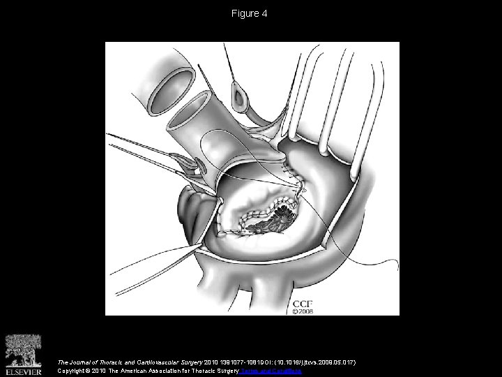 Figure 4 The Journal of Thoracic and Cardiovascular Surgery 2010 1391077 -1081 DOI: (10.