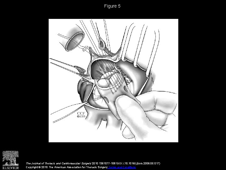 Figure 5 The Journal of Thoracic and Cardiovascular Surgery 2010 1391077 -1081 DOI: (10.