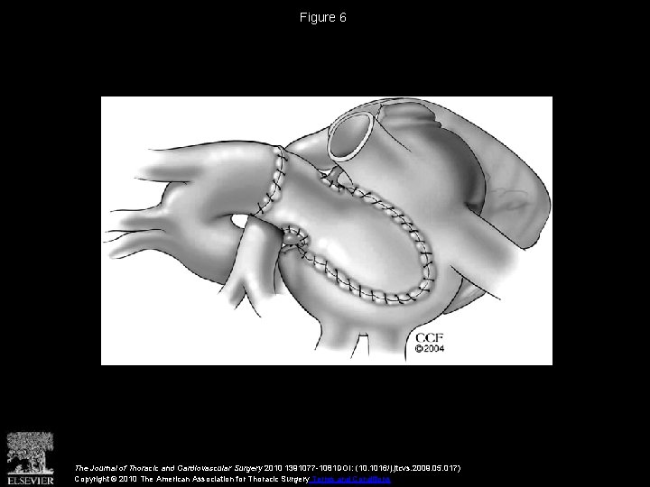 Figure 6 The Journal of Thoracic and Cardiovascular Surgery 2010 1391077 -1081 DOI: (10.