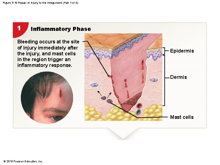 Figure 5 -16 Repair of Injury to the Integument (Part 1 of 4). 1