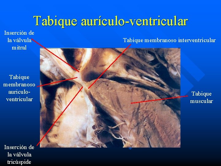 Tabique aurículo-ventricular Inserción de la válvula mitral Tabique membranoso auriculoventricular Inserción de la válvula