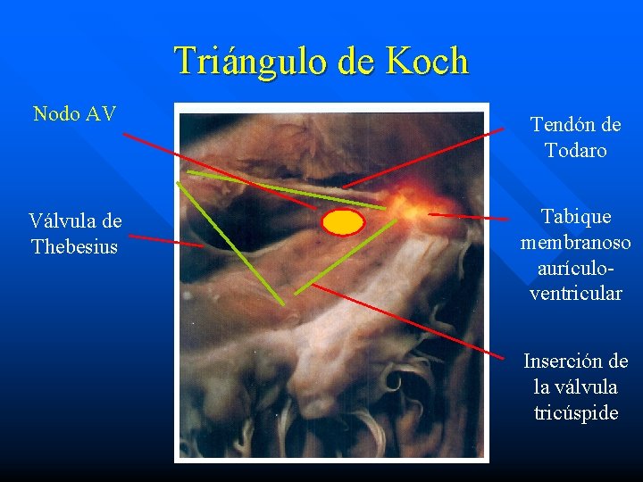 Triángulo de Koch Nodo AV Tendón de Todaro Válvula de Thebesius Tabique membranoso aurículoventricular