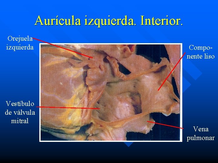 Aurícula izquierda. Interior. Orejuela izquierda Vestíbulo de válvula mitral Componente liso Vena pulmonar 