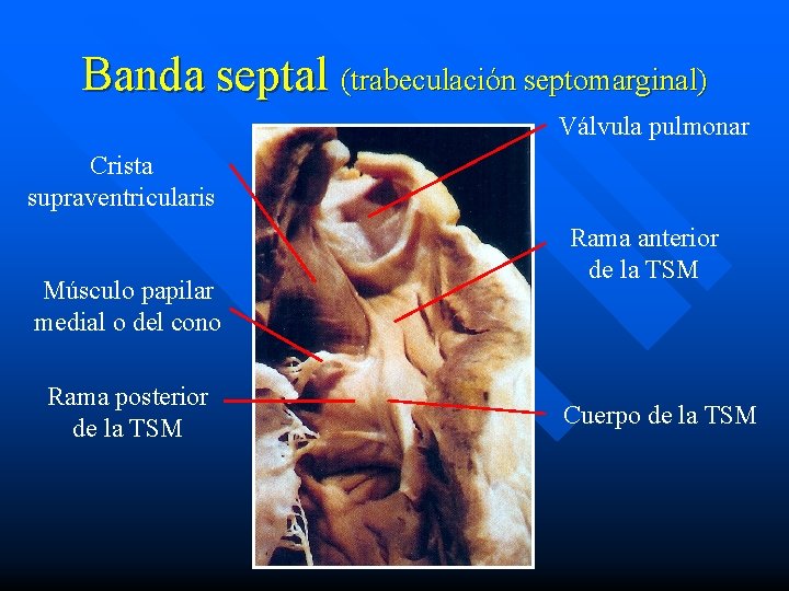 Banda septal (trabeculación septomarginal) Válvula pulmonar Crista supraventricularis Músculo papilar medial o del cono