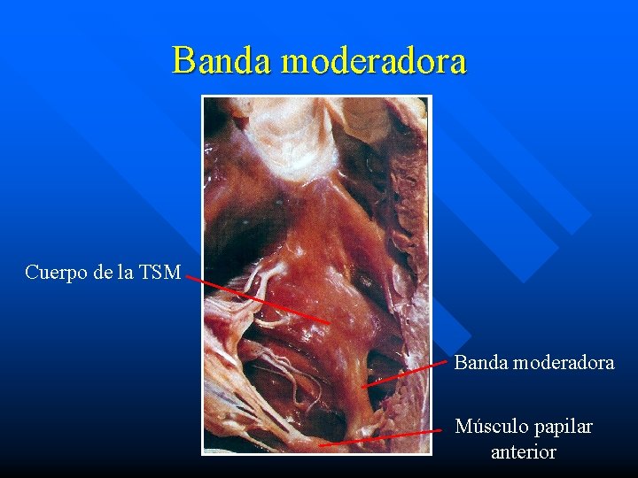 Banda moderadora Cuerpo de la TSM Banda moderadora Músculo papilar anterior 