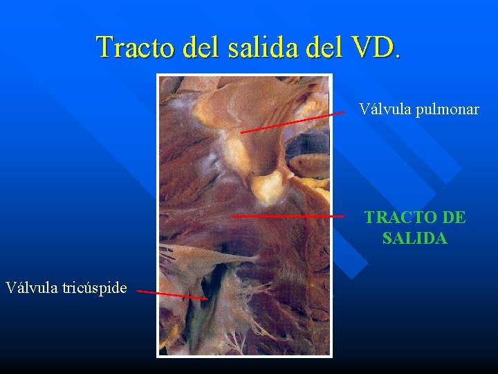 Tracto del salida del VD. Válvula pulmonar TRACTO DE SALIDA Válvula tricúspide 