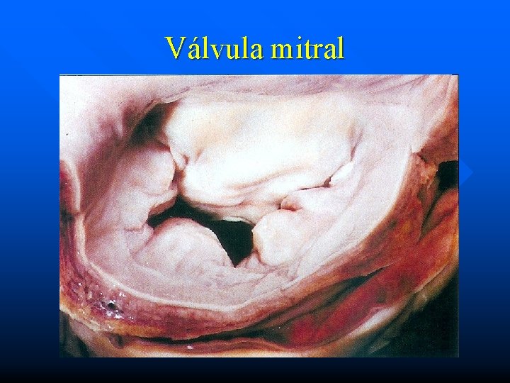 Válvula mitral 