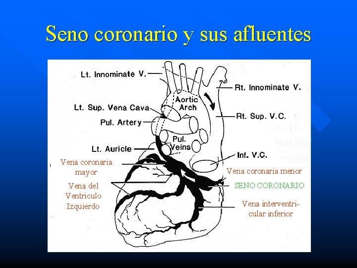 Seno coronario y sus afluentes Vena coronaria mayor Vena del Ventriculo Izquierdo Vena coronaria