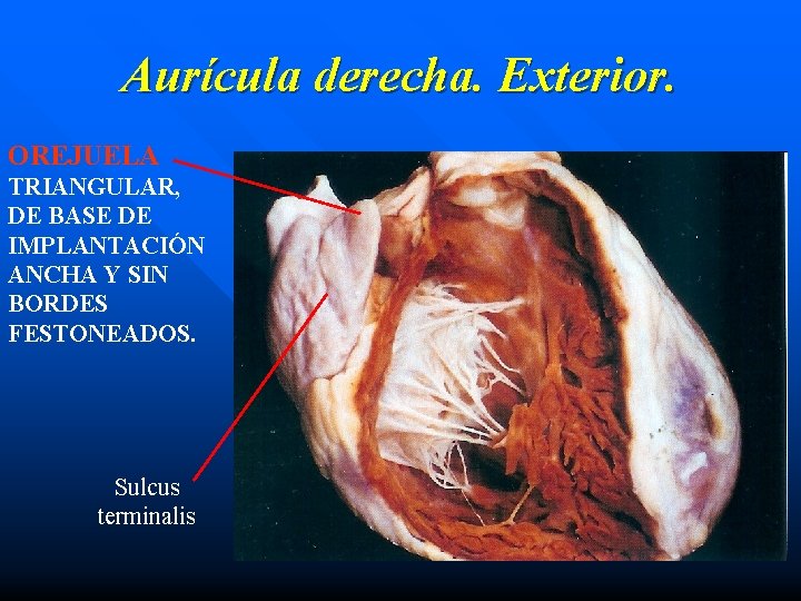 Aurícula derecha. Exterior. OREJUELA TRIANGULAR, DE BASE DE IMPLANTACIÓN ANCHA Y SIN BORDES FESTONEADOS.