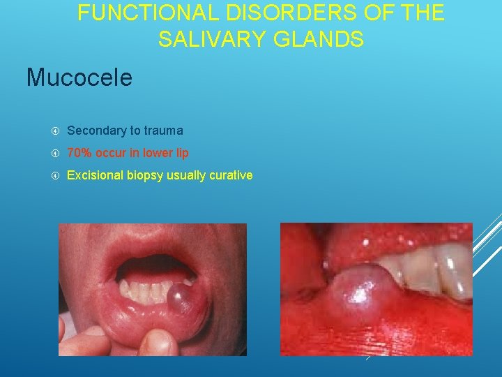 FUNCTIONAL DISORDERS OF THE SALIVARY GLANDS Mucocele Secondary to trauma 70% occur in lower