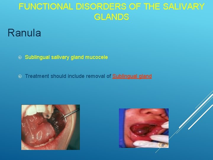FUNCTIONAL DISORDERS OF THE SALIVARY GLANDS Ranula Sublingual salivary gland mucocele Treatment should include
