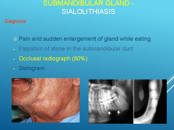 SUBMANDIBULAR GLAND SIALOLITHIASIS Diagnosis Pain and sudden enlargement of gland while eating - Palpation
