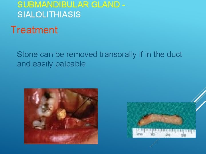 SUBMANDIBULAR GLAND SIALOLITHIASIS Treatment Stone can be removed transorally if in the duct and