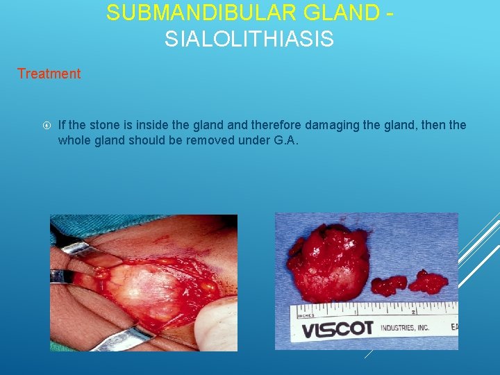 SUBMANDIBULAR GLAND SIALOLITHIASIS Treatment If the stone is inside the gland therefore damaging the