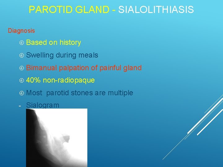 PAROTID GLAND - SIALOLITHIASIS Diagnosis Based on history Swelling during meals Bimanual 40% Most