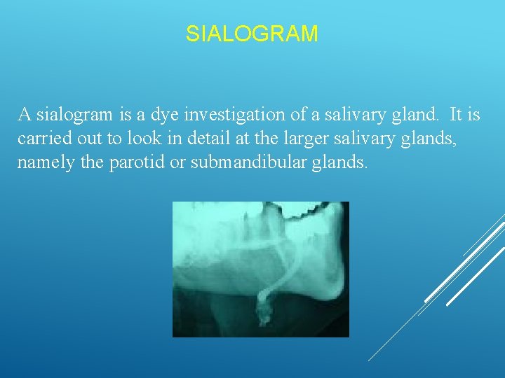SIALOGRAM A sialogram is a dye investigation of a salivary gland. It is carried