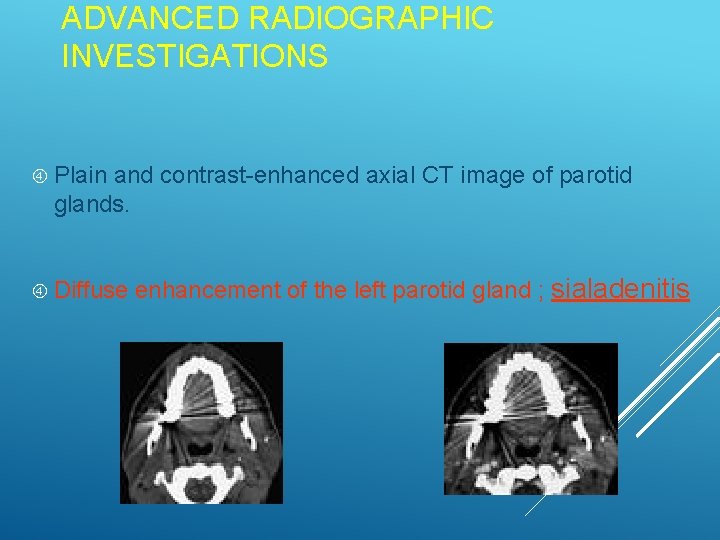 ADVANCED RADIOGRAPHIC INVESTIGATIONS Plain and contrast-enhanced axial CT image of parotid glands. Diffuse enhancement