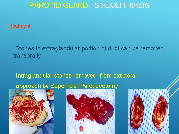 PAROTID GLAND - SIALOLITHIASIS Treatment Stones in extraglandular portion of duct can be removed