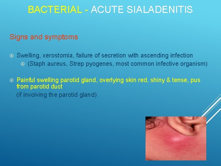 BACTERIAL - ACUTE SIALADENITIS Signs and symptoms Swelling, xerostomia, failure of secretion with ascending