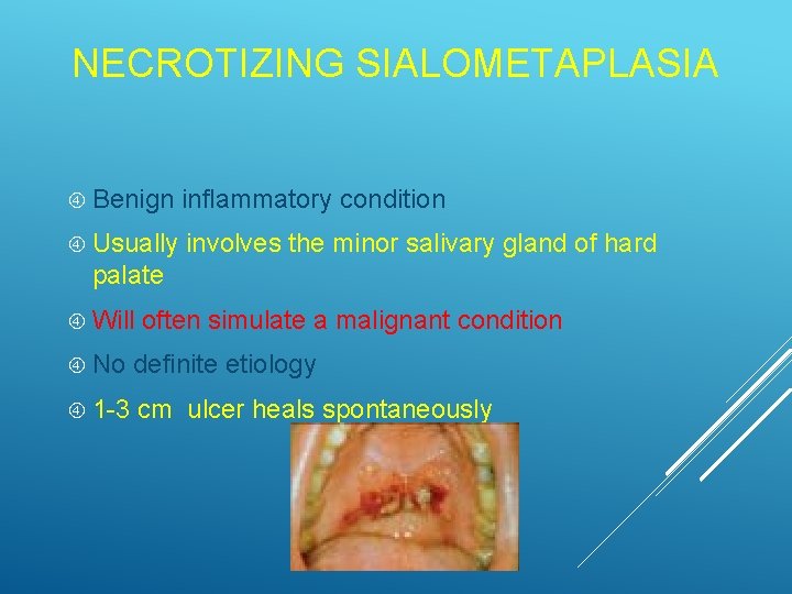 NECROTIZING SIALOMETAPLASIA Benign inflammatory condition Usually involves the minor salivary gland of hard palate
