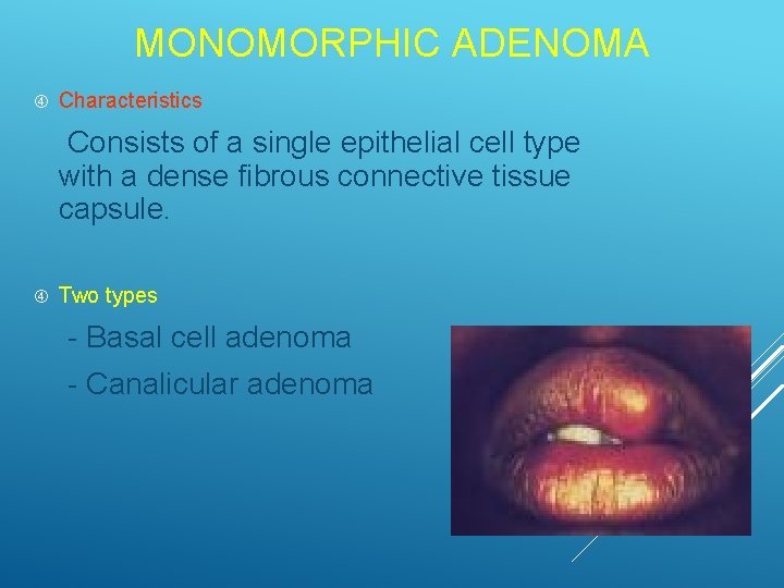 MONOMORPHIC ADENOMA Characteristics Consists of a single epithelial cell type with a dense fibrous