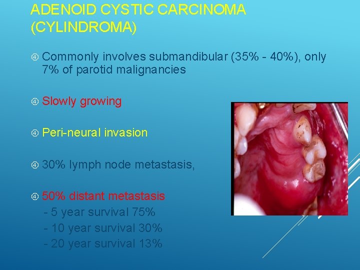 ADENOID CYSTIC CARCINOMA (CYLINDROMA) Commonly involves submandibular (35% - 40%), only 7% of parotid