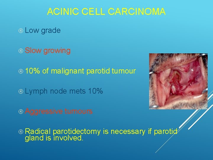 ACINIC CELL CARCINOMA Low grade Slow growing 10% of malignant parotid tumour Lymph node