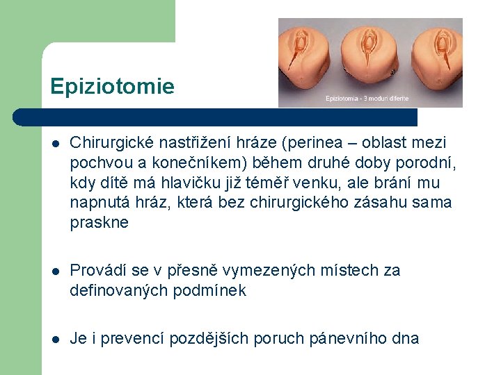 Epiziotomie l Chirurgické nastřižení hráze (perinea – oblast mezi pochvou a konečníkem) během druhé