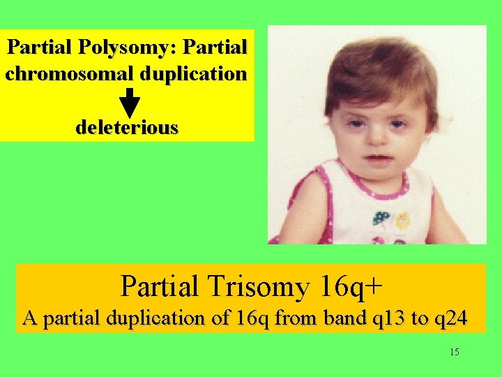 Partial Polysomy: Partial chromosomal duplication deleterious Partial Trisomy 16 q+ A partial duplication of