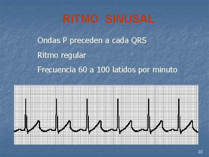 RITMO SINUSAL Ondas P preceden a cada QRS Ritmo regular Frecuencia 60 a 100