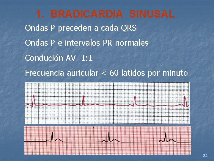 1. BRADICARDIA SINUSAL Ondas P preceden a cada QRS Ondas P e intervalos PR