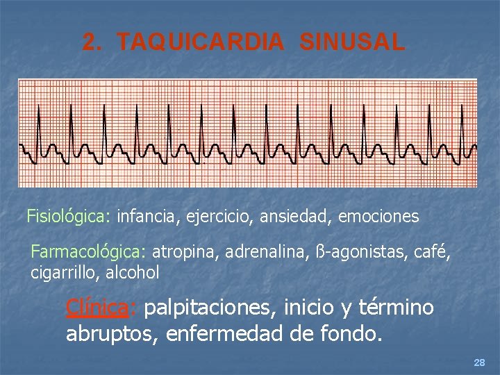 2. TAQUICARDIA SINUSAL Fisiológica: infancia, ejercicio, ansiedad, emociones Farmacológica: atropina, adrenalina, ß-agonistas, café, cigarrillo,