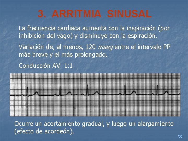 3. ARRITMIA SINUSAL La frecuencia cardiaca aumenta con la inspiración (por inhibición del vago)