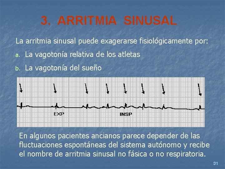 3. ARRITMIA SINUSAL La arritmia sinusal puede exagerarse fisiológicamente por: a. La vagotonía relativa