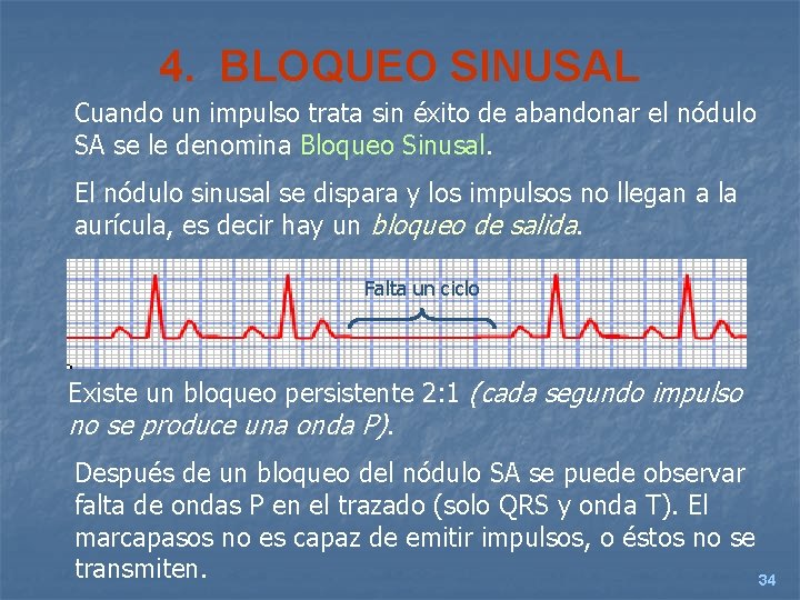 4. BLOQUEO SINUSAL Cuando un impulso trata sin éxito de abandonar el nódulo SA