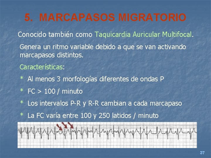 5. MARCAPASOS MIGRATORIO Conocido también como Taquicardia Auricular Multifocal. Genera un ritmo variable debido